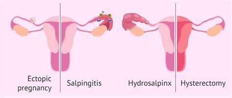 The popularity of this technique is based on its inherent simplicity and its long-established efficacy. . Heavy periods after salpingectomy